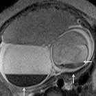 Radiological Case: Placental cyst
