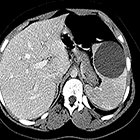 A diagnostic approach to splenic lesions