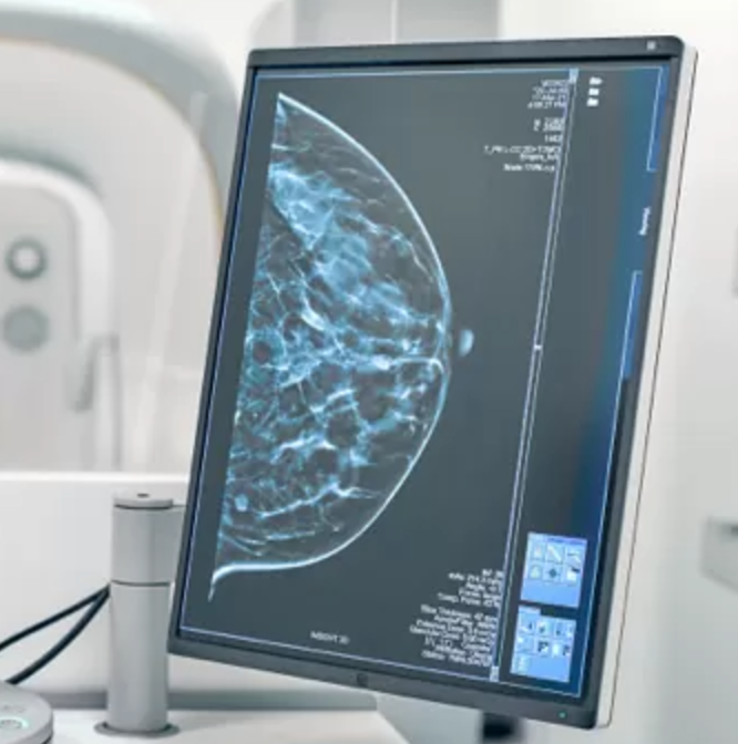 MASAI Trial Demonstrates AI-Assisted Mammography Screening Increases ...
