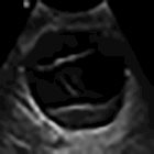 Cysts with masses and masses with cysts: An imaging review of cystic breast masses