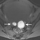 MRI of endometriosis: A comprehensive review