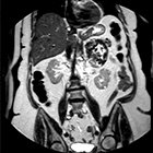 Rare case of angiosarcoma of the adrenal gland seen with multiple modalities
