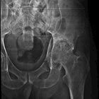 Radiological Case: Multifocal osteomyelitis