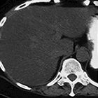 Imaging diffuse liver disease
