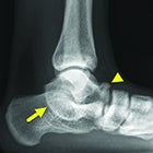 Talocalcaneal Coalition