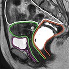 Dynamic MR imaging of pelvic floor dysfunction