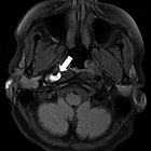 Imaging in acute trauma-induced dissection and ischemic stroke: A Review