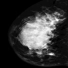 Neuroendocrine tumor of the breast