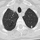 Lung cancer screening: Pros and cons