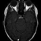 Brain capillary telangiectasia