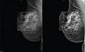 Breast cancer detection: advantage DBT •