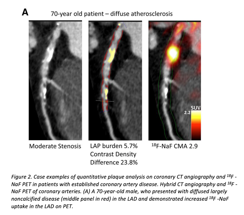 PET/CT AI Model Could Predict Heart Attacks | Applied Radiology