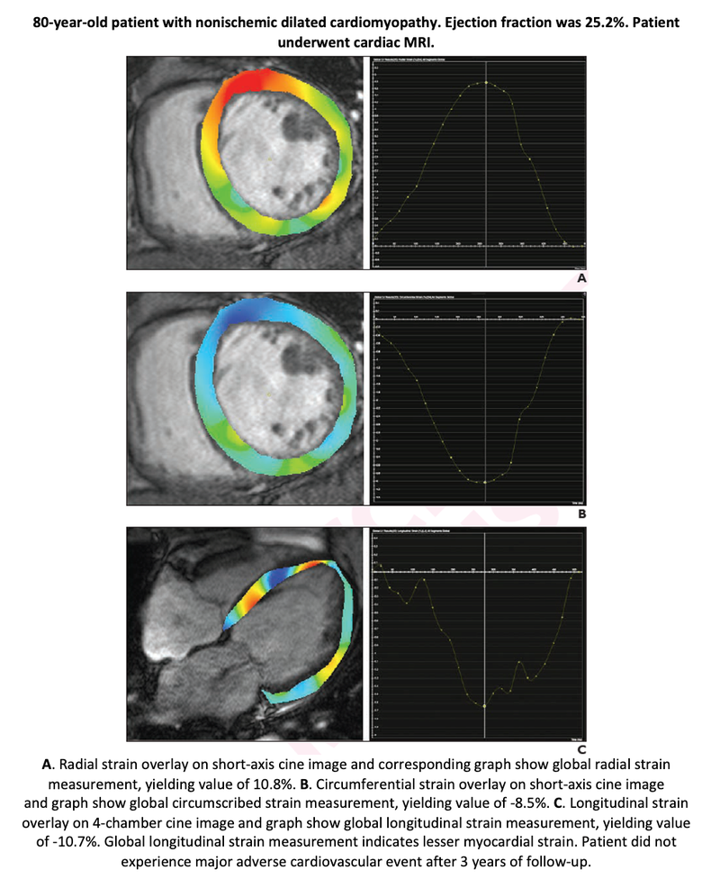 Myocardial Strain a Predictor of Adverse Outcomes in Dilated ...
