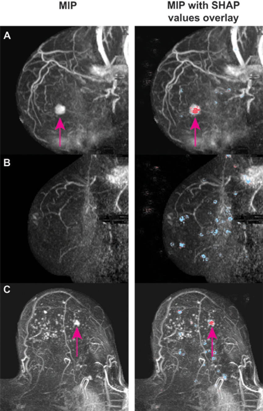 AI provides accurate breast density classific