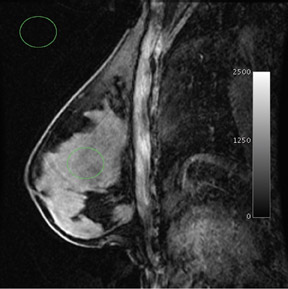 Breast Magnetic Resonance Imaging (MRI)