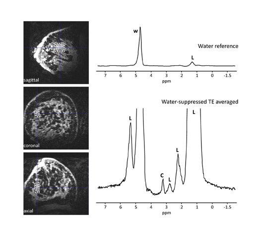 Hyperecho-Turbo Spin-Echo Sequences at 3T: Clinical Application in  Neuroradiology