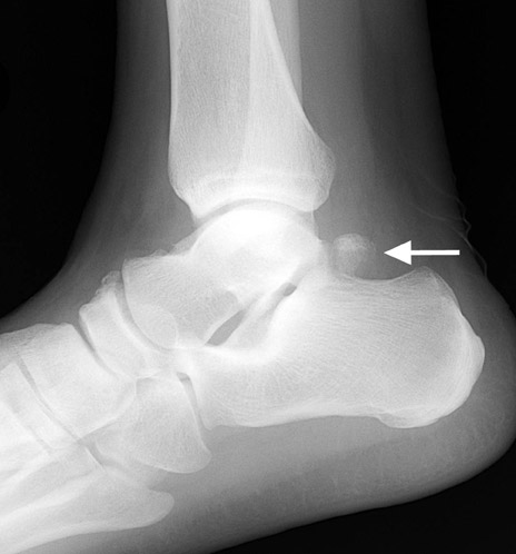 Accessory ossicles and sesamoid bones: Spectrum of pathology and ...