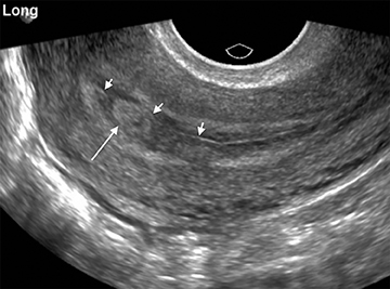 Bleeding in Early Pregnancy