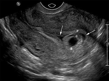 How to approch a case of bleeding in early pregnancy with case