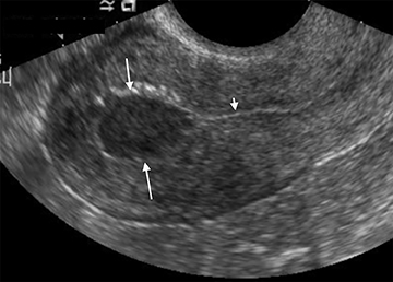Imaging of vaginal bleeding in early pregnancy • APPLIED RADIOLOGY