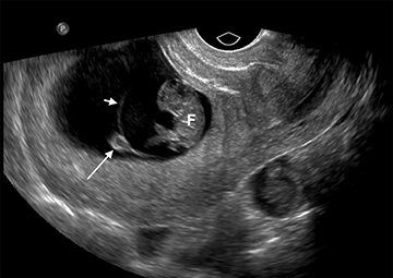 Imaging of vaginal bleeding in early pregnancy • APPLIED RADIOLOGY