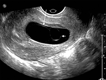 TMI POST* White particles in urine during early pregnancy (approx 6-8  weeks). Could this be a symptom of miscarriage? : r/PregnancyUK