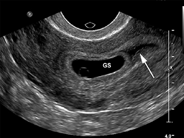 Gestational Sac in Pregnancy and Meaning If Empty