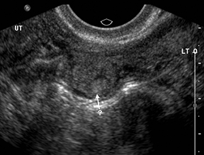 Spotting During Pregnancy – Is It Normal? - Ultrasound Dimensions