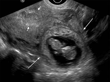 The significance of ultrasound features of sub-chorionic