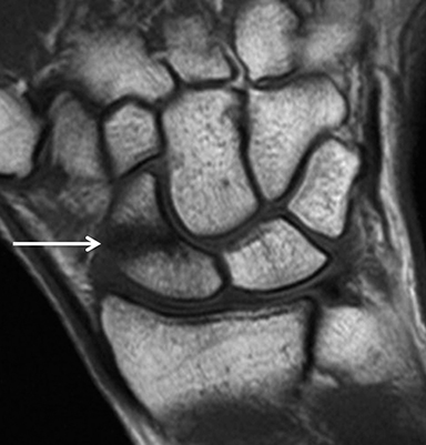 ulnar collateral ligament wrist mri