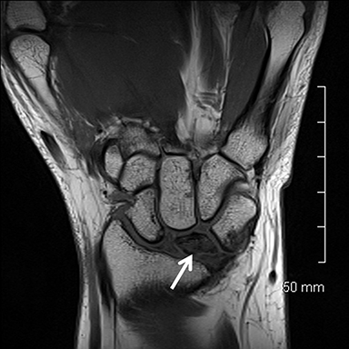 ulnar collateral ligament wrist mri