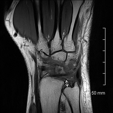 ulnar collateral ligament wrist mri