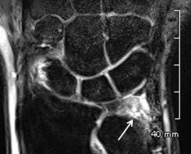 MRI of the wrist • APPLIED RADIOLOGY