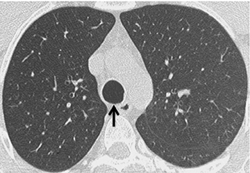 Anatomy of the lungs, mediastinum and heart at MDCT