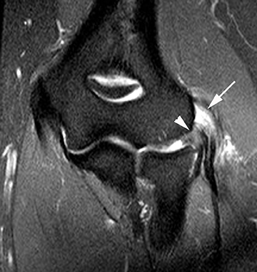 olecranon bursitis mri