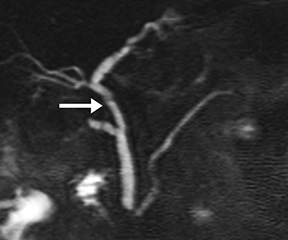 pancreas divisum mrcp