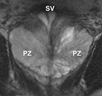 prostate gland anatomy mri