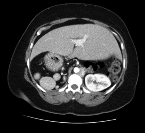 Case Review: Heterotaxy syndrome with polysplenia • APPLIED RADIOLOGY