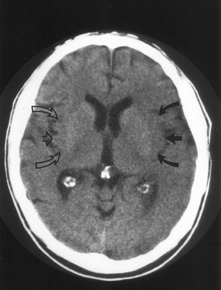 Imaging of acute stroke • APPLIED RADIOLOGY