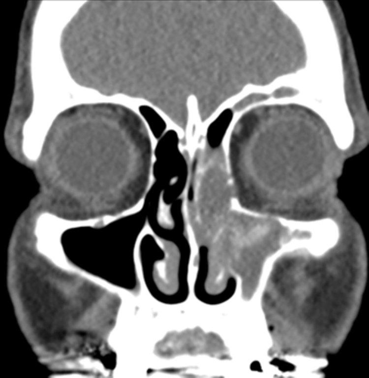 Paranasal deals sinus disease