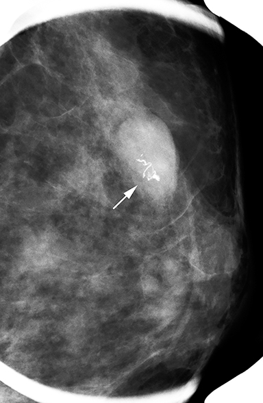 a) Photograph of a woman's breast shows slitlike retraction of the