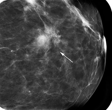 Benign Breast Changes That Mimic Breast Cancer