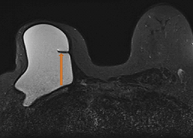 MR imaging of breast implants: Useful information for the interpreting  radiologist • APPLIED RADIOLOGY