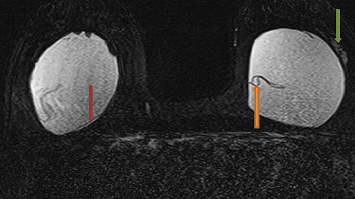 Silicone gel-filled implants. T2-weighted (a), silicone-only (b), and