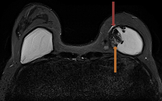 Breast MRI Findings: Breast Implant - Radiology