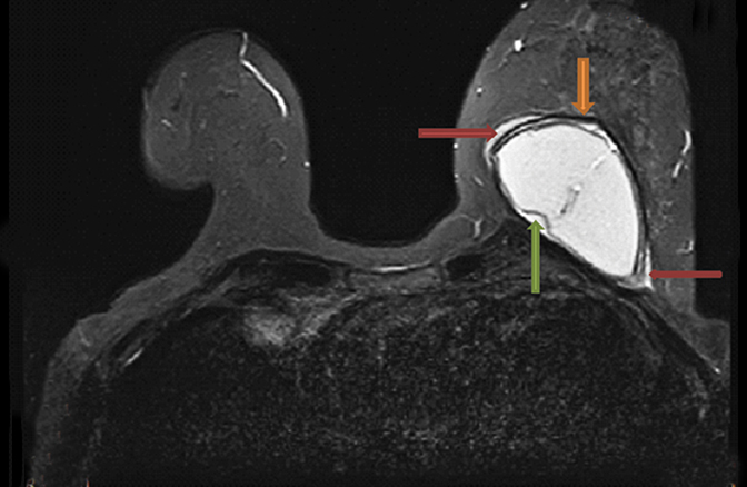 Breast MRI Findings: Breast Implant - Radiology