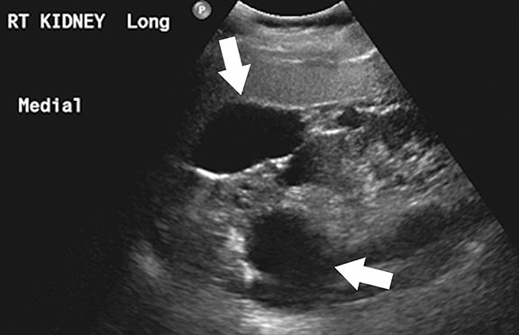 adult polycystic kidney disease ultrasound