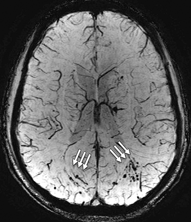 Diffusion Tensor Imaging in Traumatic Brain Injury