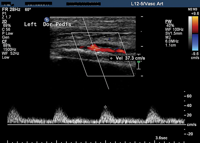 Stewart-Bluefarb syndrome • APPLIED RADIOLOGY