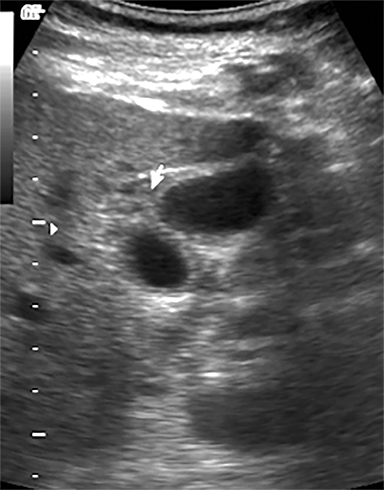 Imaging infection and inflammation of the terminal ileocecal region ...